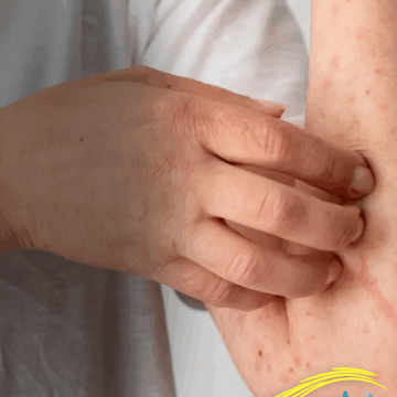 Guerrero, entre 74 casos de sarampión y 441 en fase de confirmación