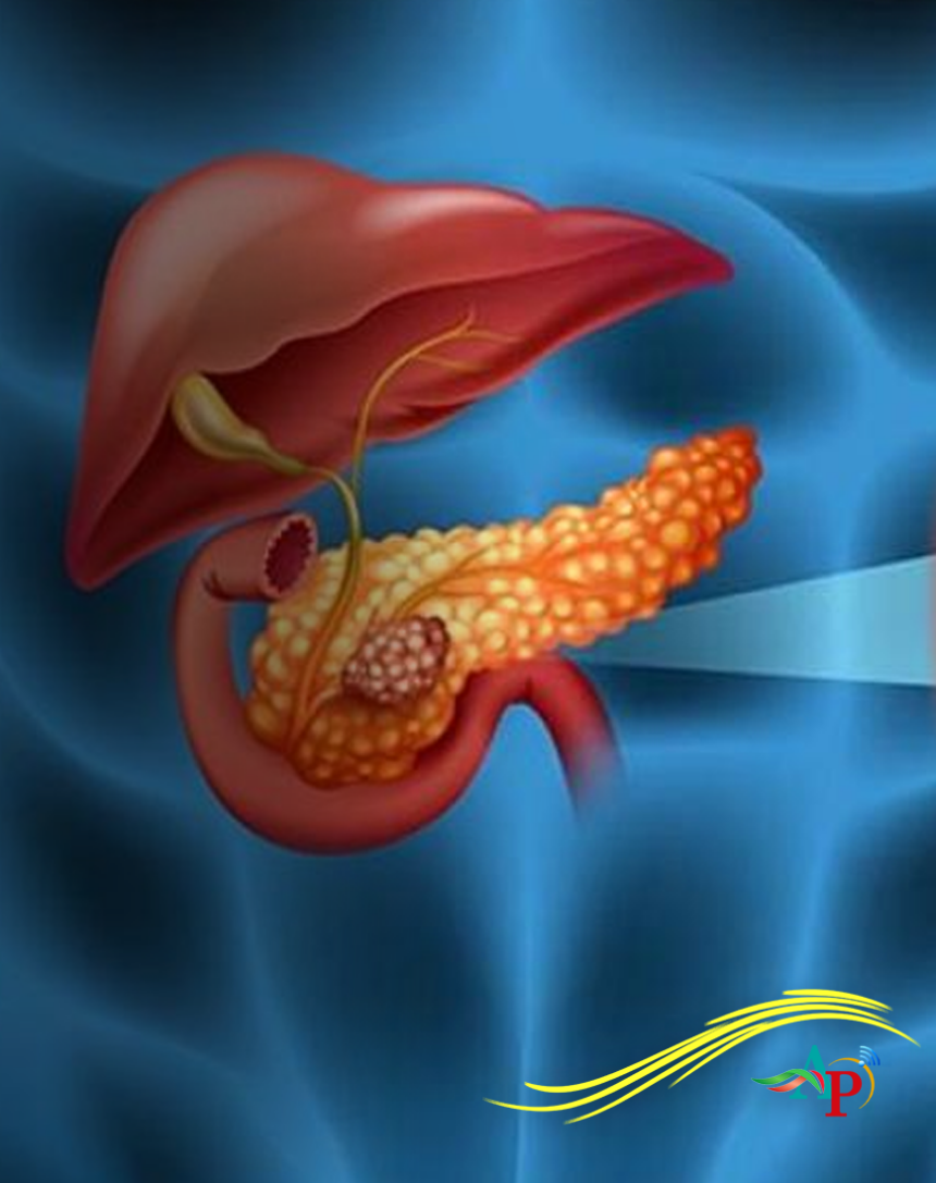 Científicos españoles logran eliminar el cáncer de páncreas