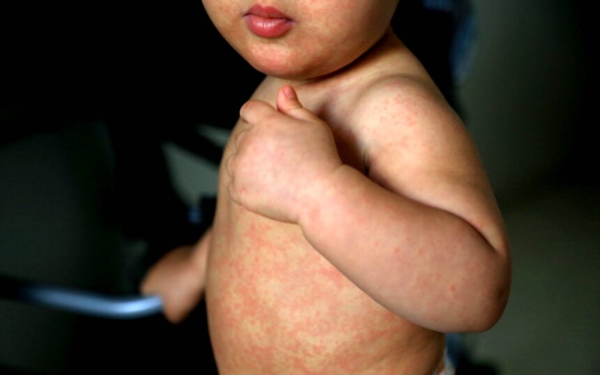 SARAMPION CDMX CDMX confirma segunda muerte por sarampión